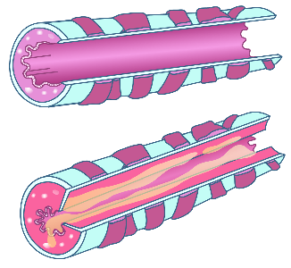 Bronchitis