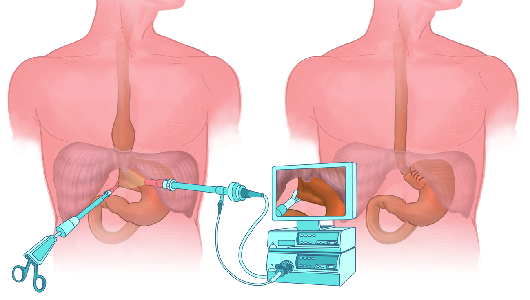 Fundoplicatio