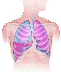 Haematothorax