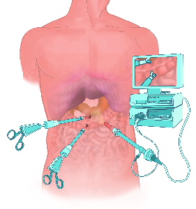 Laparoskopische OP