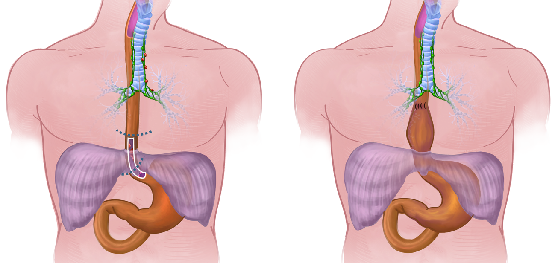 Oesophagektomie