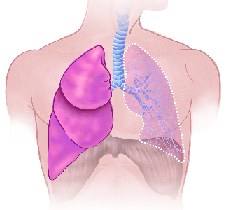 Pneumoektomie