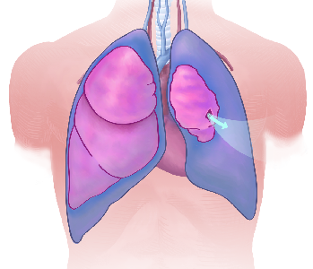 Pneumothorax