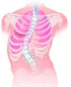 Skoliose