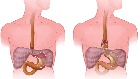 Gastrooesophagealer Reflux